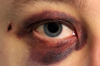 black-eye-330x220